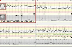 Centrale de surveillance obstétricale Mosos, 64 lits