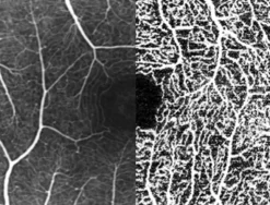 Upgrade Module OCT-Angiographie
